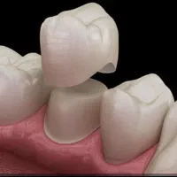 روکش دندان با قیمت بسیار مناسب