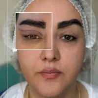 بلفاروپلاستی/سانترال لب/ لیفت ابرو،شقیقه/ بوکال فت