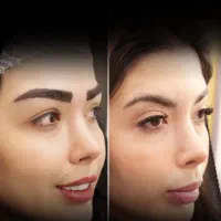 کاشت ابرو ،بلفارو،رفع غبغب،تزریق چربی