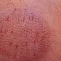 حجامت و بادکش درمانی و خدمات پرستاری تحت نظره پزشک