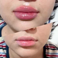 ژل لب کانتور صورت مزوژل جوانسازی آنزیم بینی بوتاکس