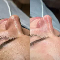 تخفیف فیشیال وپاکسازی همراه اسیدتراپی به مدت۱۰روز