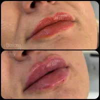 ژل لب،بوتاکس،نخ لیفت ، فول فیس، پی آر پی