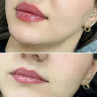 مرکز تزریق ژل بوتاکس جراحی لیفت ابرو ،چربی و..