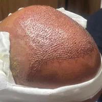 کاشت مو و کاشت ابرو اقساطی و تضمینی|خدمات آرایشگری و زیبایی|ارومیه, |دیوار