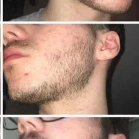 تقویت حرفه ای فولیکول