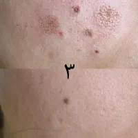 خدمات ریموو تتو صورت وجوانسازی صورت|خدمات آرایشگری و زیبایی|اصفهان, شهرک ولیعصر|دیوار