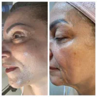 فشیال درمانی‌ رفع ۷۰ درصد اختللات پوستی