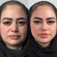 تزریق فیلر و بوتاکس در کلینیک پوست و لیزر سهرابی|خدمات آرایشگری و زیبایی|کرمانشاه, |دیوار