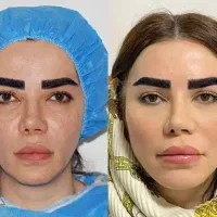 رفع غبغب ژنیکوماستی رفع تیرگی زیر چشم رفع جای زخم