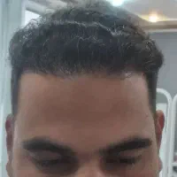 کاشت مو فول تراکم اقساطی برای اولین بار در رفسنجان