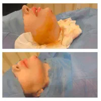 تخفیف خاص لیپوساکشن فیلر بوتاکس