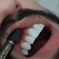 تخفیف ویژه کامپوزیت زیبایی و دندانپزشکی|خدمات آرایشگری و زیبایی|کرج, شاهین‌ویلا|دیوار