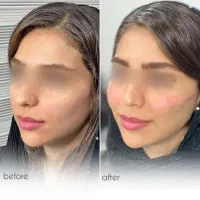 کلینیک زیبایی ژل لب روسی فیلر زاویه مزوبوتاکس لیزر|خدمات آرایشگری و زیبایی|شهریار, شهریار|دیوار