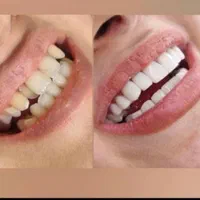 دندانپزشکی ستارخان اقساط ایمپلنت کامپوزیت عصبکشی|خدمات آرایشگری و زیبایی|تهران, صادقیه|دیوار