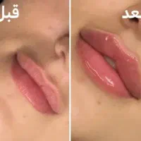 مدل ژل/فیلر لب|خدمات آرایشگری و زیبایی|تهران, قلهک|دیوار