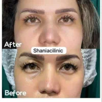 جراحی بلفاروپلاستی|خدمات آرایشگری و زیبایی|تهران, هفت حوض|دیوار