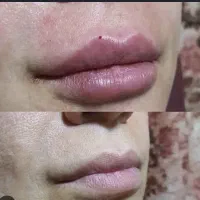 نیاز مند مدل فیلر بوتاکس نخ prp