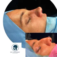 جراحی بینی بدون تامپون«نقد و اقساط ۴ ماهه»