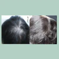 میکرواسکالپ سر|خدمات آرایشگری و زیبایی|گرگان, |دیوار