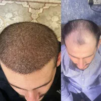 کاشت مو VIP شیراز و نوراباد