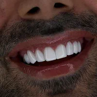 دندان لیمنت کامپوزیت ایمپلنت با استفاده هوش مصنوعی|خدمات آرایشگری و زیبایی|مشهد, دانشجو|دیوار
