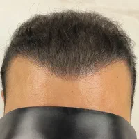 پرپشتی مو در سه روز بدون کاشتمو|خدمات آرایشگری و زیبایی|جهرم, |دیوار