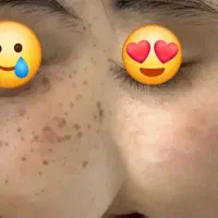 جشنواره تخفیف خال و لک برداری