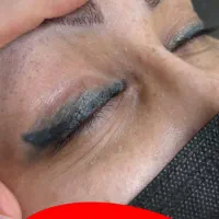 لیزر موهای زائد،ریمو تاتو
