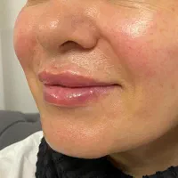 ژل وبوتاکس حمیدیه..|خدمات آرایشگری و زیبایی|حمیدیه, |دیوار