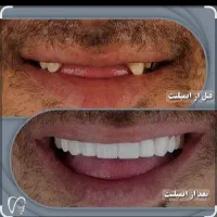 ایمپلنت دندان /اقساط ۱۰ ماهه/آف ویژه