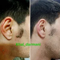 برداشتن خال زگیل و میخچه با محلول صدر صد گیاهی|آرایشی، بهداشتی، درمانی|کرمان, |دیوار