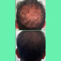 سرم تخصصی با فرمولاسیون جدید گیاهی