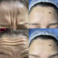مطب پزشک.ژل وبوتاکس.لیفت بانخ.فیلربینی ژل آلت|خدمات آرایشگری و زیبایی|قم, دورشهر|دیوار