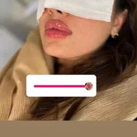 تزریق ژل و بوتاکس پک مادلینگ، مزونیدلینگ ۵۰٪تخفیف|خدمات آرایشگری و زیبایی|پردیس, فاز ۱|دیوار