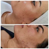 جشنواره آموزش فیشیال تخصصی،فیلروبوتاکس درسهند