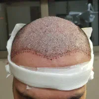 جشنواره کاشت مو دکتر راکعی .اقساط ۱۲ ماهه بدون سود|خدمات آرایشگری و زیبایی|اراک, |دیوار