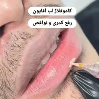 رفع تیرگی لب ،میکرواسکالپ موی سر آقایون