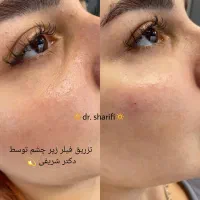 جشنواره ۵۰ درصدی ژل و بوتاکس توسط جناب دکتر شریفی|خدمات آرایشگری و زیبایی|قم, بلوار امین و ساحلی|دیوار