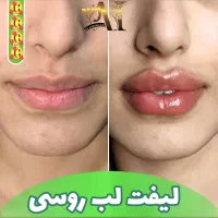 تزریق انواع بوتاکس ژل پی آر پی نخ لیفت آنزیم بینی