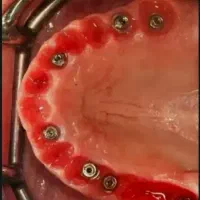 جشنواره ویژه دندانپزشکی و ایمپلنت در تبریز