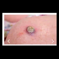 تا ۲۰ فروردین تخفیفات 70درصدی برداشت خال و زگیل