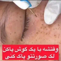 درمان تضمینی لک و کک و مک و خال /فقط در 1 جلسه