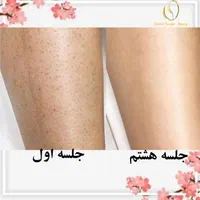 لیزر موهای زائد صورت وبدن،  جوانسازی پوست|خدمات آرایشگری و زیبایی|رفسنجان, |دیوار