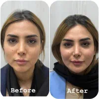 مدل بوتاکس و پی ار پی و کانتورینگ صورت با فیلر|خدمات آرایشگری و زیبایی|اصفهان, ملک‌شهر|دیوار