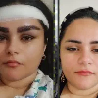 کاشت ابرو فقط در یک جلسه