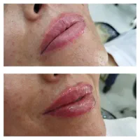 تزریق ژل هرسی سی فقط 900تومان