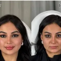 ژل لب بوتاکس زیر بغل فیلر بادی لیفت شقیقه نخ لیفت|خدمات آرایشگری و زیبایی|اصفهان, فیض|دیوار