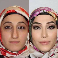 رینو جراحی عمل زیبایی بینی چربی لیپو سانترال پلک|خدمات آرایشگری و زیبایی|تهران, ونک|دیوار