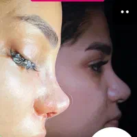 جشنواره جراحی بینی|خدمات آرایشگری و زیبایی|بروجرد, |دیوار